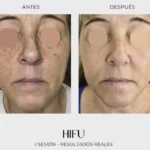 resultado primera sesion hifu facial luxury beauty vilanova