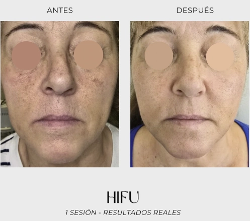 resultado primera sesion hifu facial luxury beauty vilanova