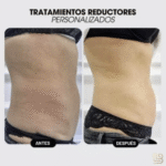 tratamientos personalizados, antes y despues, Luxury Beauty Estetica, Vilanova i la Geltr&uacute;